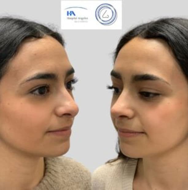 Rinoplastia Estética