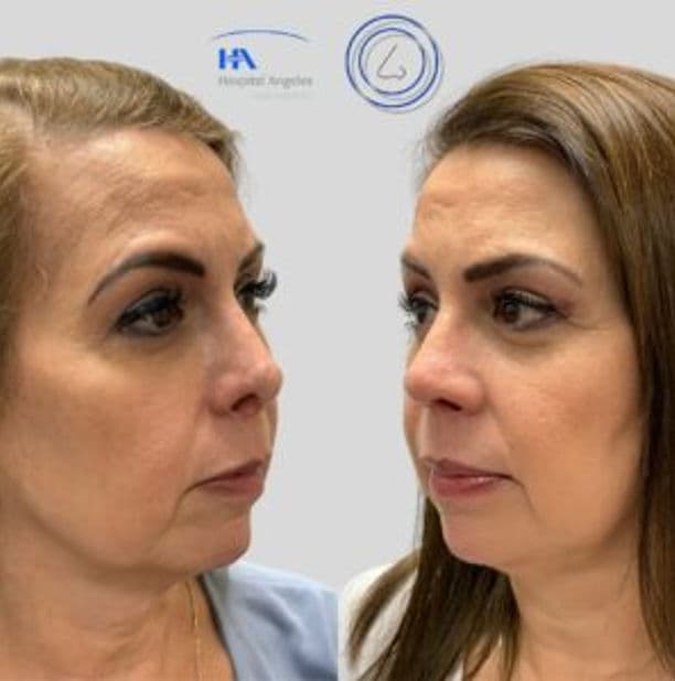 Rinoplastia Funcional