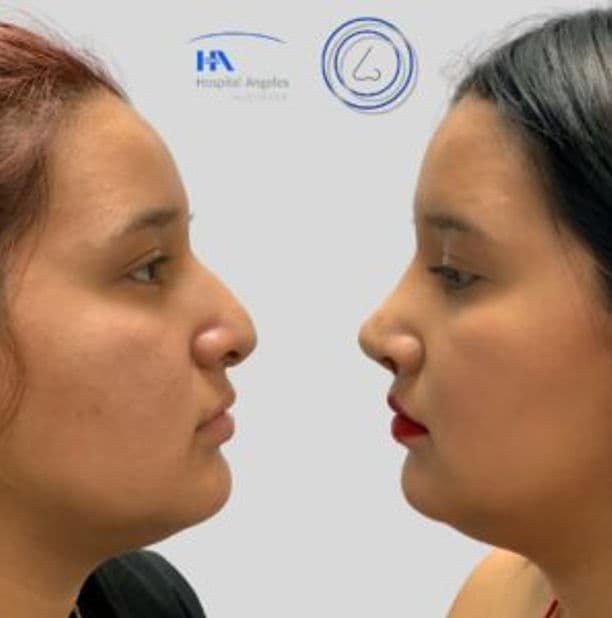 Revisión de Rinoplastia