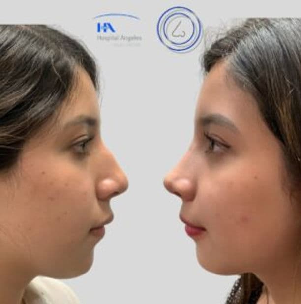 Resultado rinoplastia 4