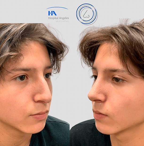 Resultado rinoplastia 5