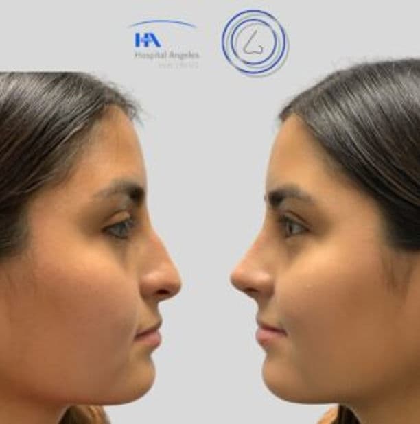 Resultado rinoplastia 6