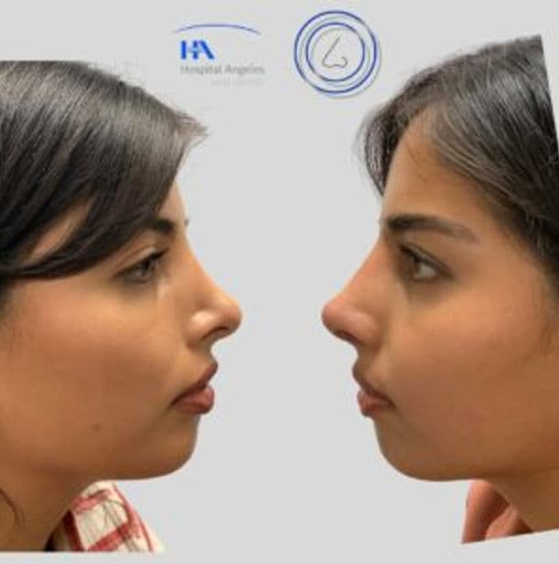 Resultado rinoplastia 7