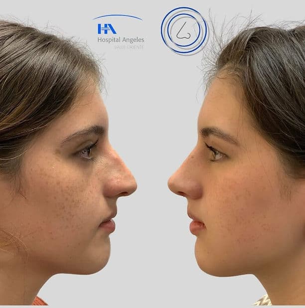 Resultado rinoplastia 8